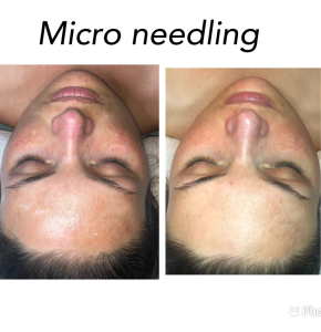 Micro-Needling 1