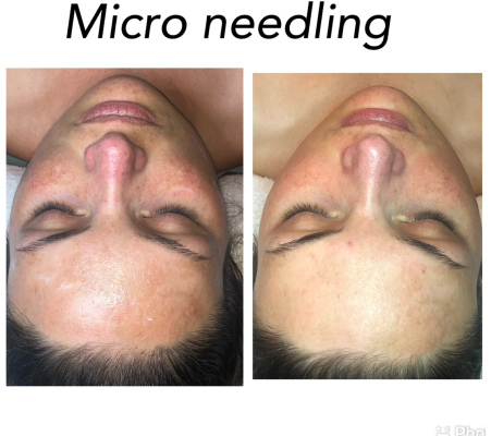 Micro-Needling 1